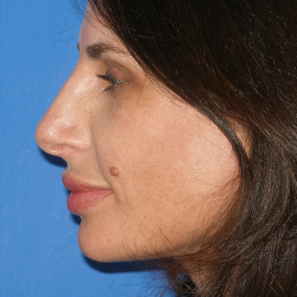 Bezoperační neinvazivní rhinoplastika – korekce nosu | Klinika Mediestetik