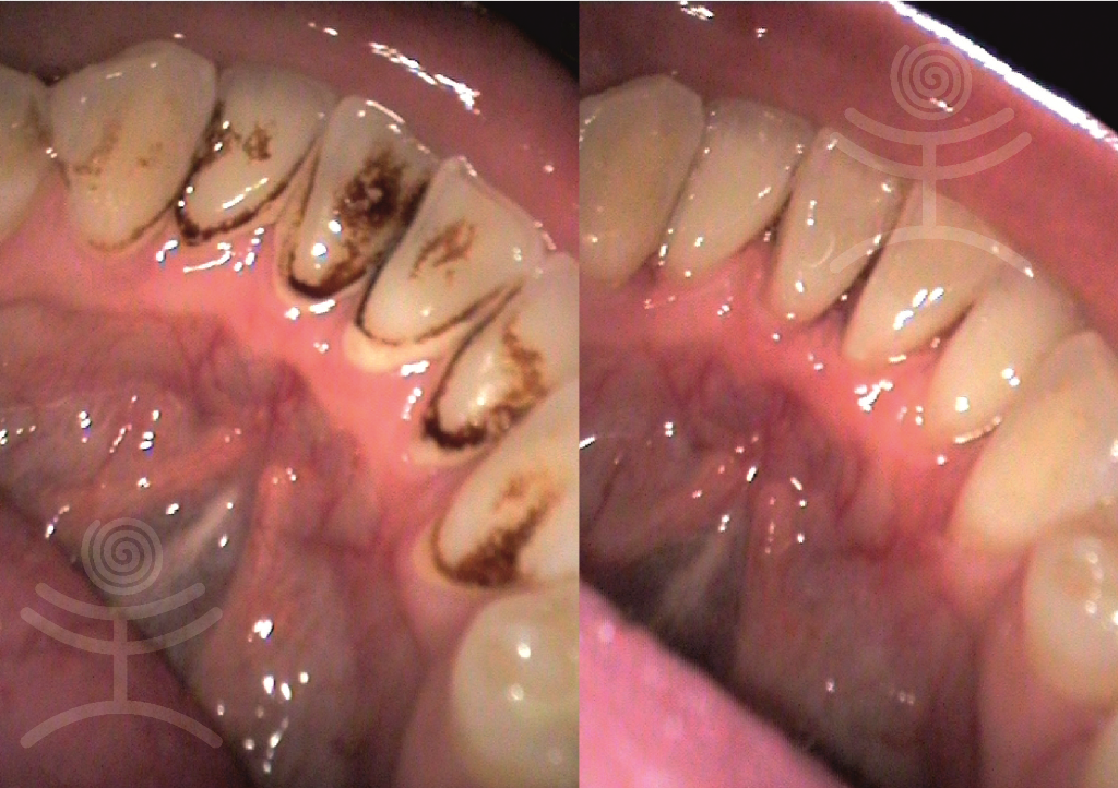 Dentální hygiena před a po | Klinika Mediestetik