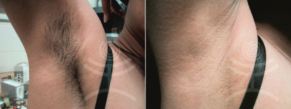 1 rok po epilaci laserem  | Klinika Mediestetik