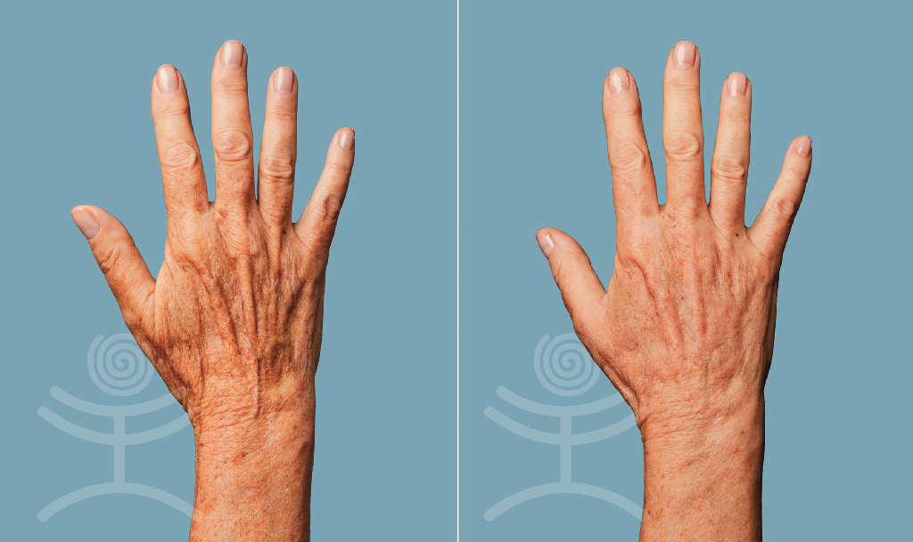 Dermální výplně hřbetů rukou | Klinika Mediestetik