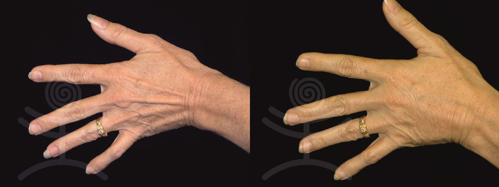 Dermální výplně hřbetů rukou | Klinika Mediestetik