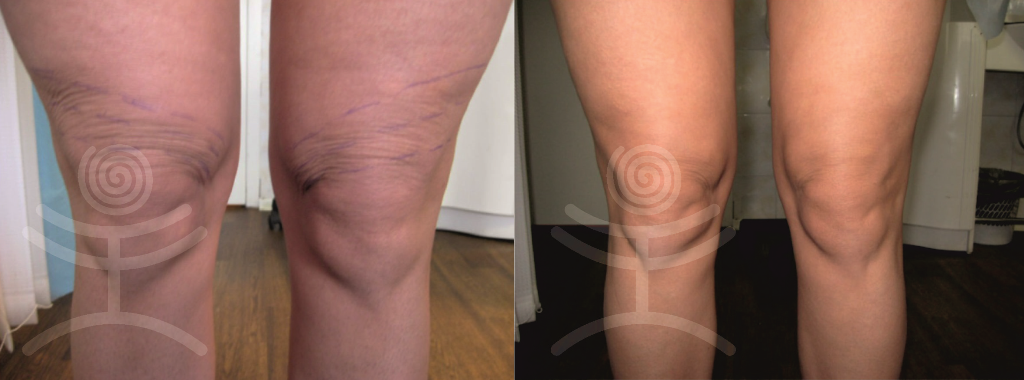 Ošetření kolen mezonitěmi | Klinika Mediestetik