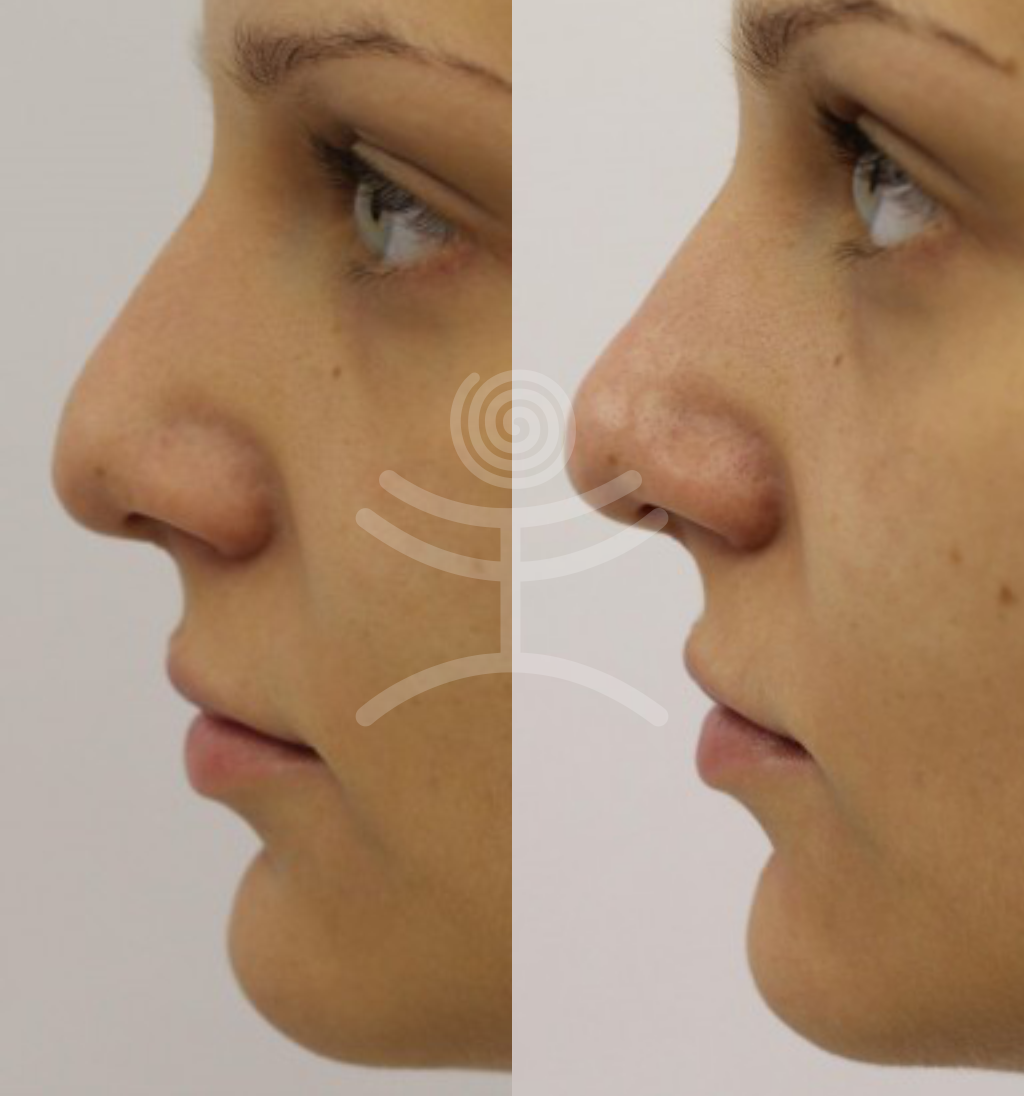 Neinvazivní rhinoplastika | Klinika Mediestetik