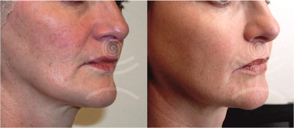 Ošetření obličeje RegenPlazma | Klinika Mediestetik