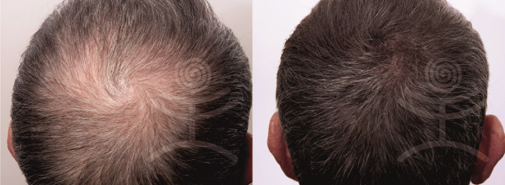 Ošetření vlasů RegenPlazma | Klinika Mediestetik
