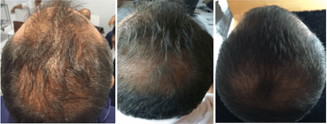 Ošetření vlasů Regenera | Klinika Mediestetik