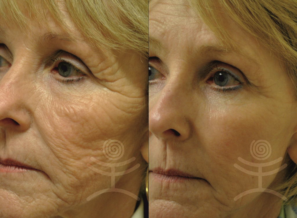 Resurfacing obličeje | Klinika Mediestetik