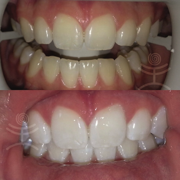 Bělení zubů Zoom3 | Klinika Mediestetik