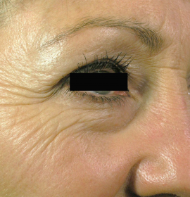 Laserový peeling a omlazení obličeje Palomar | Klinika Mediestetik