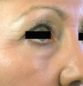 Laserpeeling und Verjüngung von Gesicht Palomar | Klinika Mediestetik