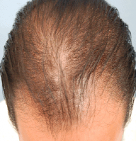 DNA terapie ztráty vlasů RegenPlazma | Klinika Mediestetik