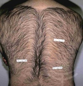 Laser Hair Removal | Klinika Mediestetik
