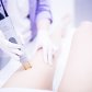 Epilation mit alexandrinischen Laser | Klinika Mediestetik