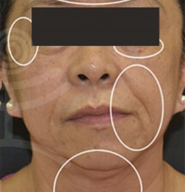 Mantis - pulzní antiaging ošetření | Klinika Mediestetik