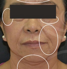 Mantis - pulzní antiaging ošetření | Klinika Mediestetik