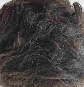 Long Hair Transplant for Women Without Shaving | Klinika Mediestetik