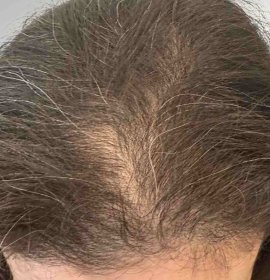 Long Hair Transplant for Women Without Shaving | Klinika Mediestetik