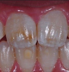 ICON: Caries Treatment without Drilling | Klinika Mediestetik