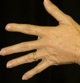 Dermal Fillers: Neck, Hands | Klinika Mediestetik