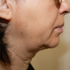 SMAS lifting - neinvazivní lifting obličeje a očí | Klinika Mediestetik