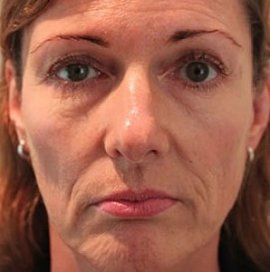 3D Facial Modelling | Klinika Mediestetik