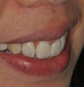 Zubní šperky SKYCE | Klinika Mediestetik