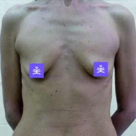 Augmentace prsou – zvětšení prsou | Klinika Mediestetik