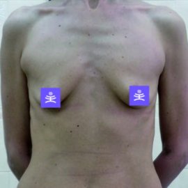 Breast plastic surgery: Enlargement | Klinika Mediestetik