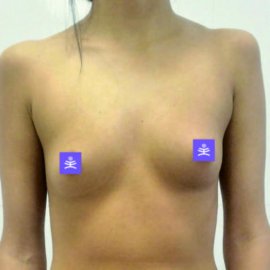 Fat Transfer to buttocks and breasts | Klinika Mediestetik