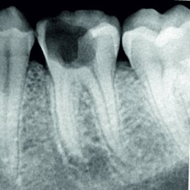 Endodontie: Die Behandlung der Zahnkanäle | Klinika Mediestetik