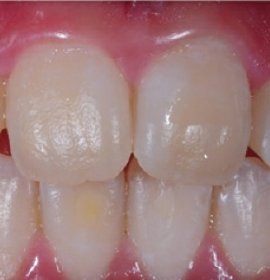 ICON: Caries Treatment without Drilling | Klinika Mediestetik