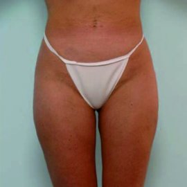 Liposuction | Klinika Mediestetik