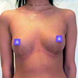 Fat Transfer – zvětšení prsou vlastním tukem | Klinika Mediestetik