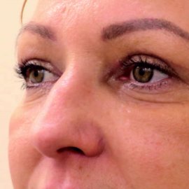 Eyelid plastic surgery: Blepharoplasty | Klinika Mediestetik