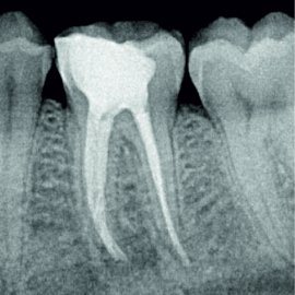 Endodontie: Die Behandlung der Zahnkanäle | Klinika Mediestetik