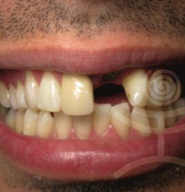 Die Zahnimplantate | Klinika Mediestetik