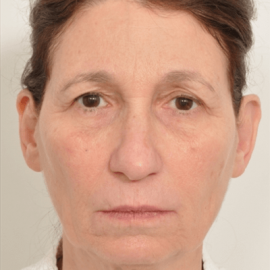 Forehead and eyebrows lifting - Brow Lift PRO-U American technique | Klinika Mediestetik