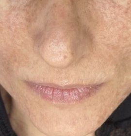 MCT – buněčné omlazení (exozomy) | Klinika Mediestetik