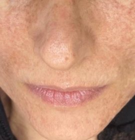 MCT – Zelluläre Verjüngung | Klinika Mediestetik