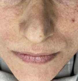 MCT – buněčné omlazení (exozomy) | Klinika Mediestetik