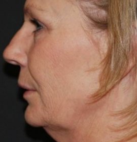 Neinvazivní lifting obličeje Thermage | Klinika Mediestetik