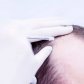 Micrografting: Obnova růstu vlasů a intenzivní biorevitalizace pokožky | Klinika Mediestetik