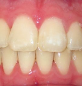 Ortodoncie a ortodontická léčba | Klinika Mediestetik