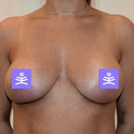 Breast plastic surgery: Modelling | Klinika Mediestetik