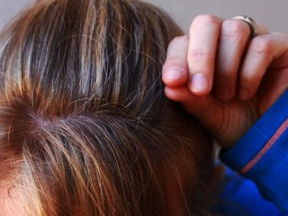 Problematika řídnoucích vlasů | Klinika Mediestetik