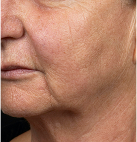 Omlazení pokožky obličeje frakčním laserem Fraxel | Klinika Mediestetik