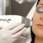 Facial rejuvenation by fractional Fraxel Laser | Klinika Mediestetik