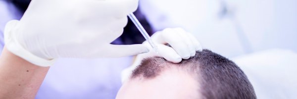 RegenPlasma: Get Rid of Hair Loss on a Cellular Level