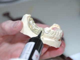 Znáte všechny druhy zubních náhrad a protéz? | Klinika Mediestetik